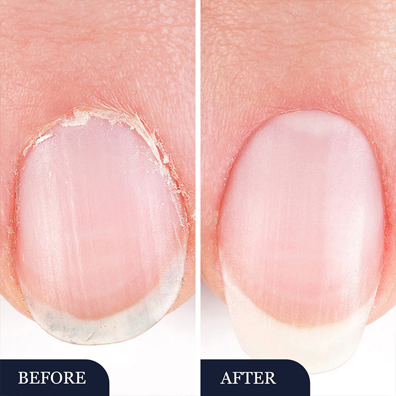 ✨ Nuovi Arrivi 🔥 Penna per il trattamento della micosi delle unghie dei piedi per unghie danneggiate